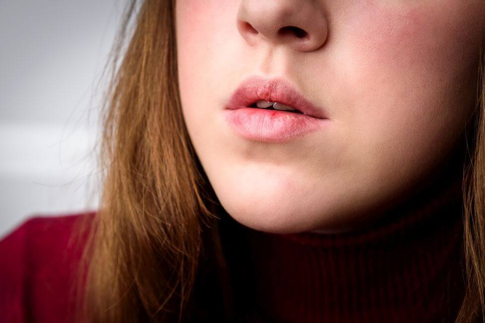 pękające usta - jak poradzić sobie z pękającymi ustami suche usta