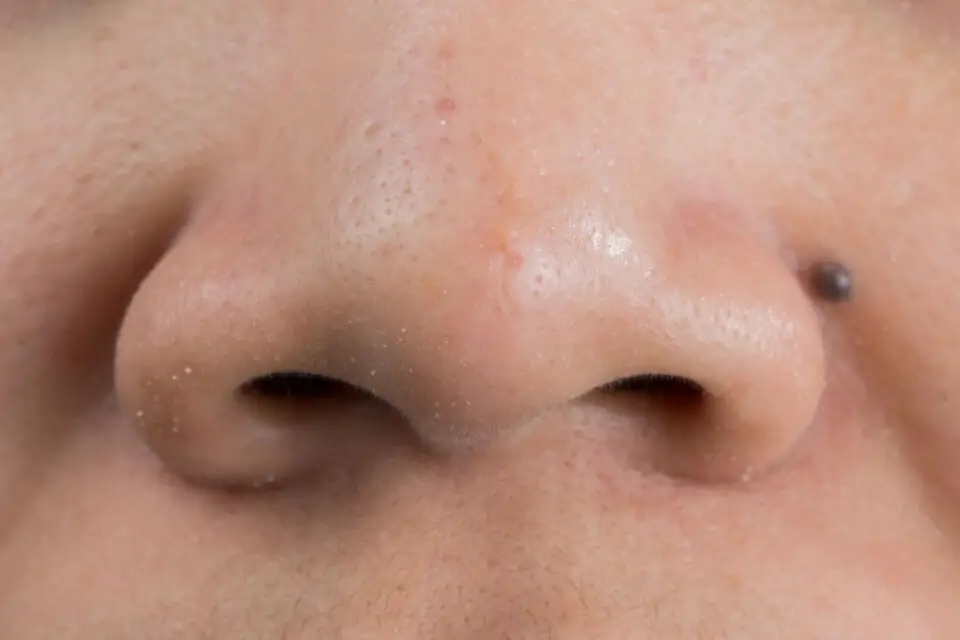 wągry na nosie nos