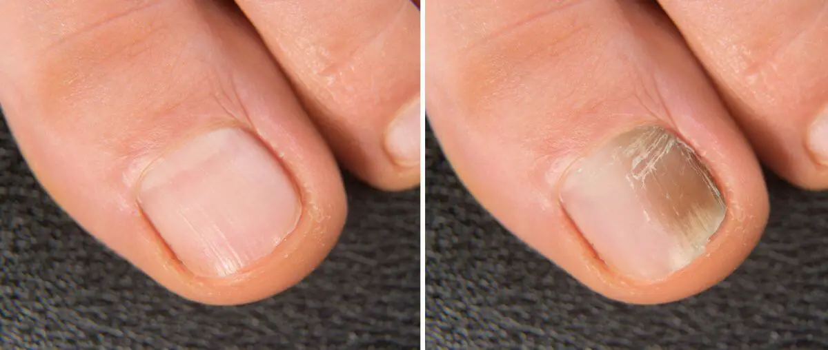 laserowe leczenie grzybicy paznokci