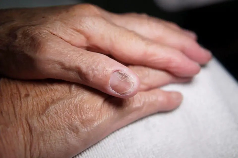 laserowe leczenie grzybicy paznokci dłonie