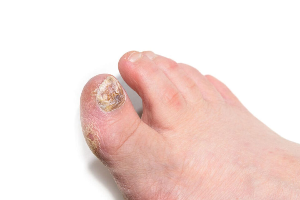 laserowe leczenie grzybicy paznokci palec u stopy