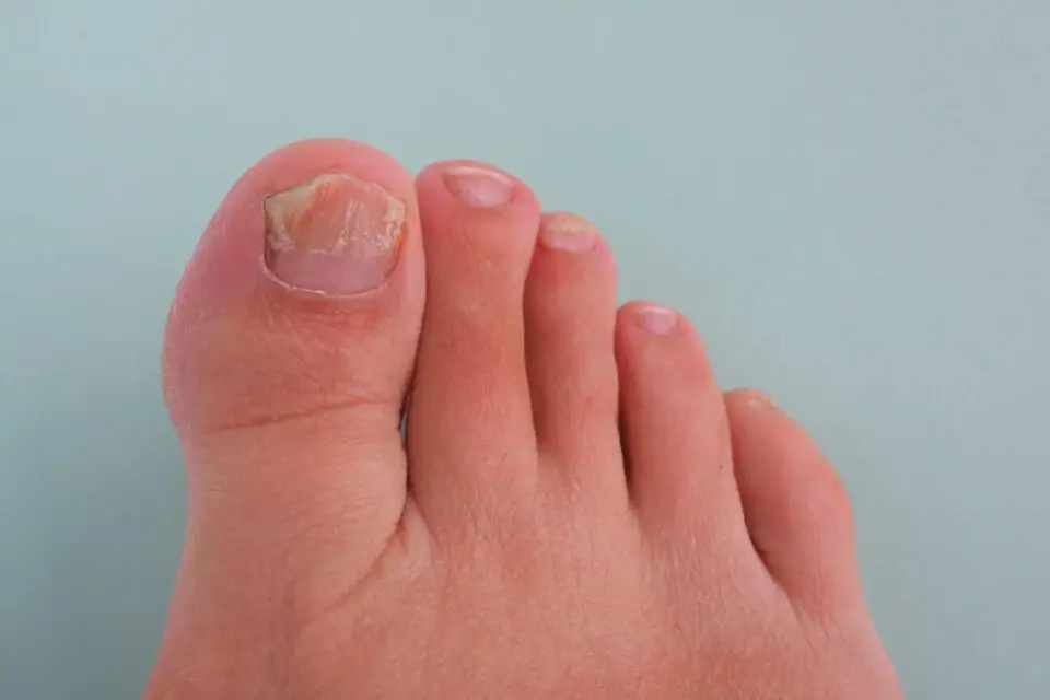 laserowe leczenie grzybicy paznokci stopa