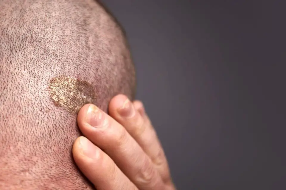 grzybica skóry głowa