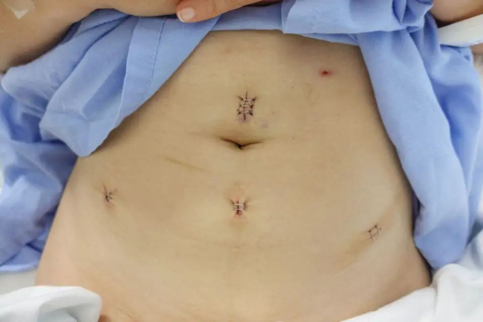 laparoskopia blizny brzuch