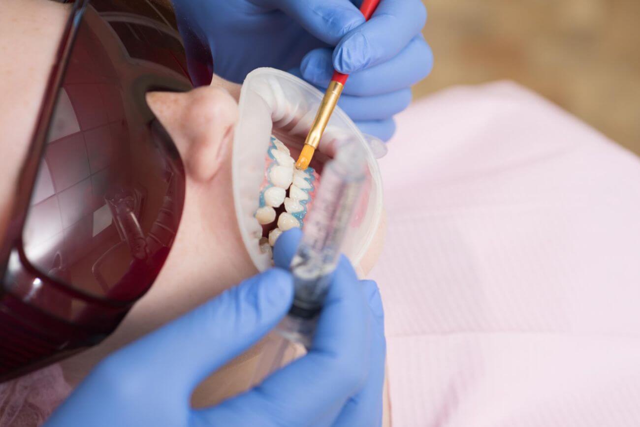 laserowe wybielanie zębów