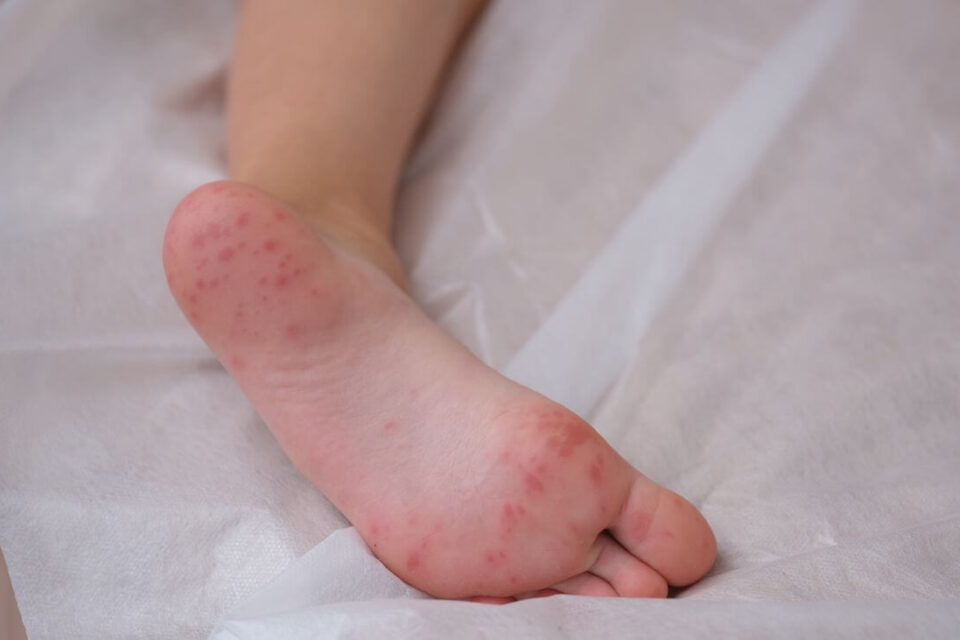 wysypka alergiczna stopa