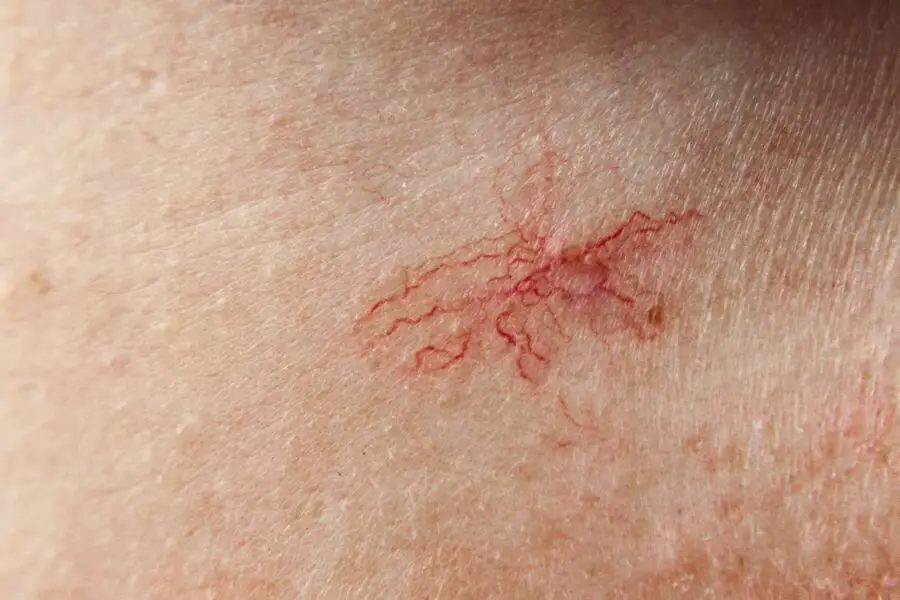 czerwone plamy na ciele - skóra naczynkowa
