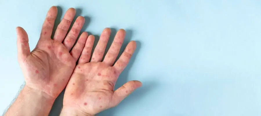 czerwone plamy na ciele - zmiany skórne na dłoniach

