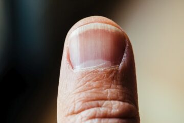 Łuszczyca paznokci – jakie są jej objawy? Leczenie łuszczycy paznokci